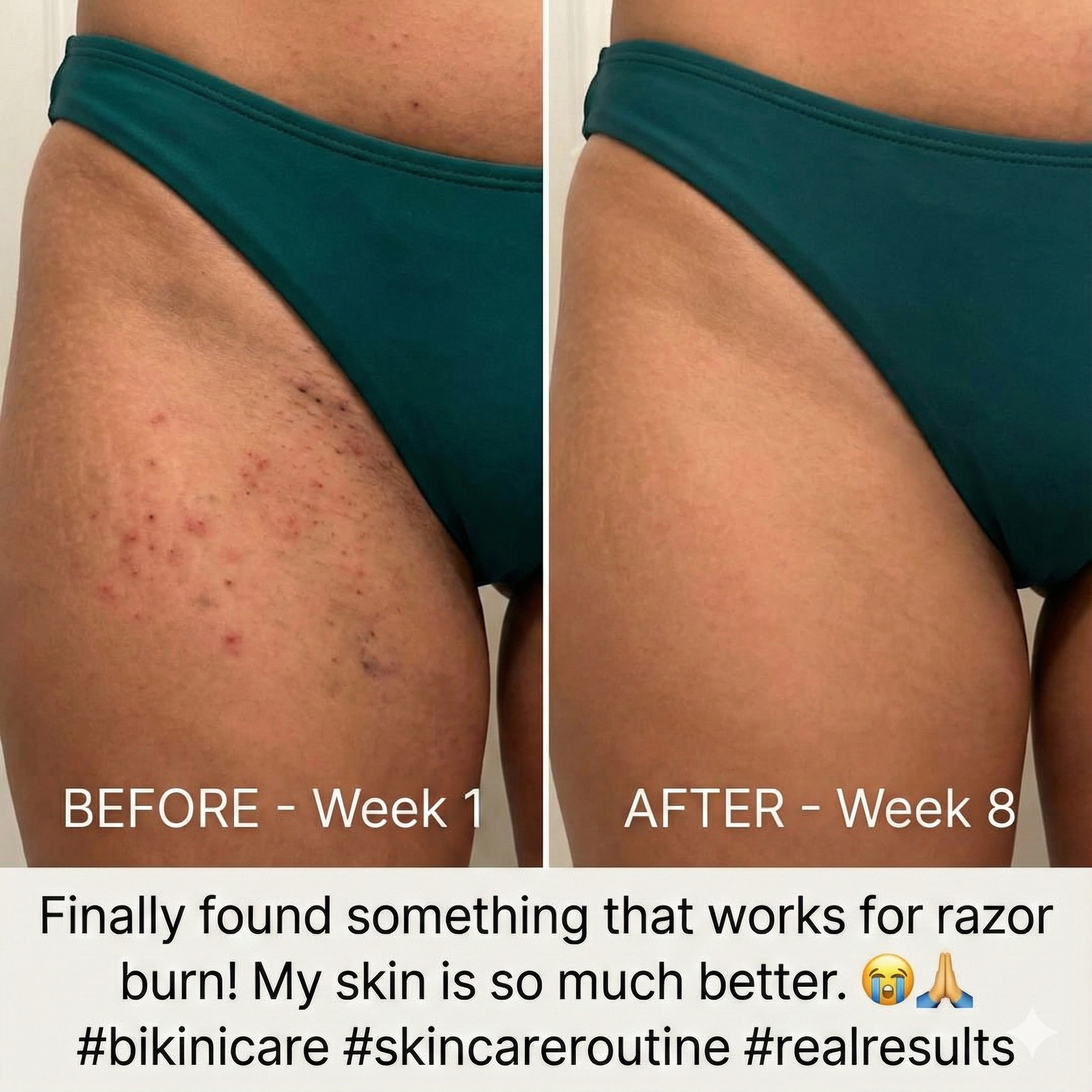 Inner thigh results - Before and After