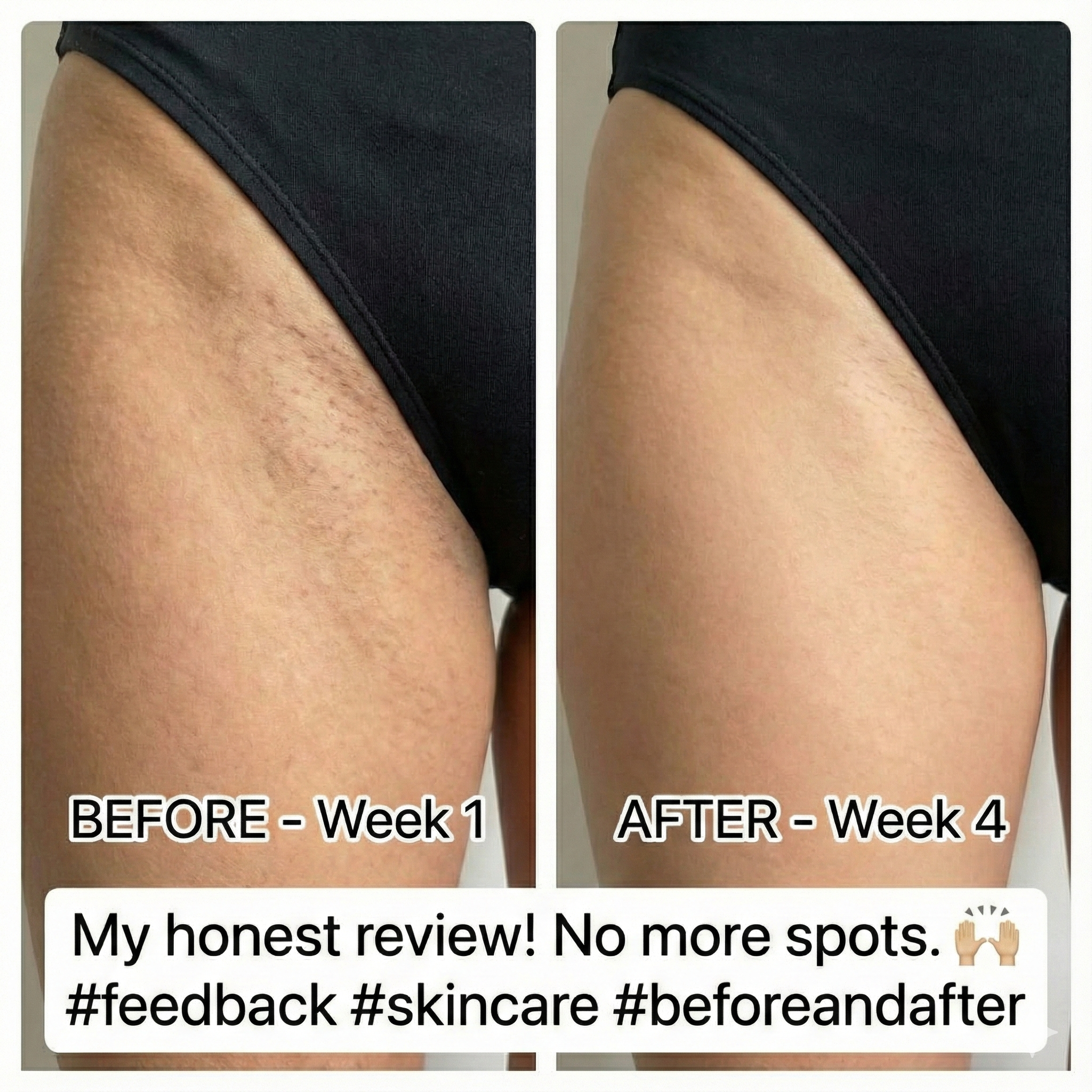 Inner thigh results - Before and After