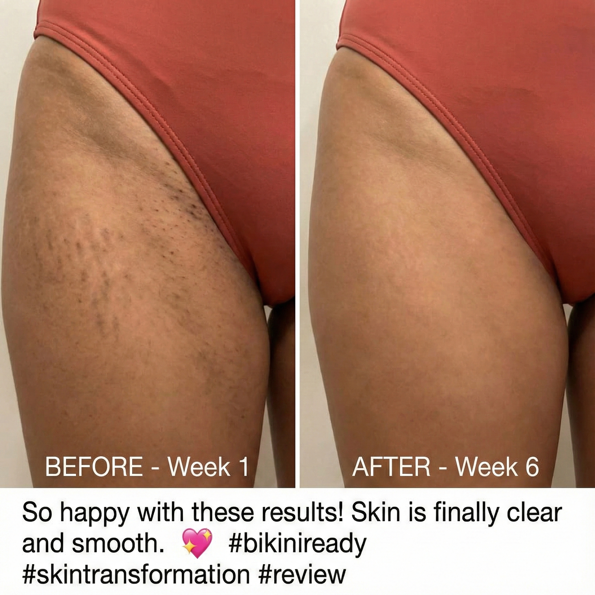 Inner thigh results - Before and After